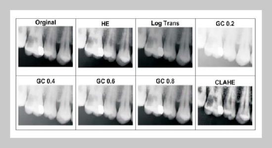 Brightness Preserving Enhancement for Dental Digital X-ray Images Based on Entropy and Histogram Analysis